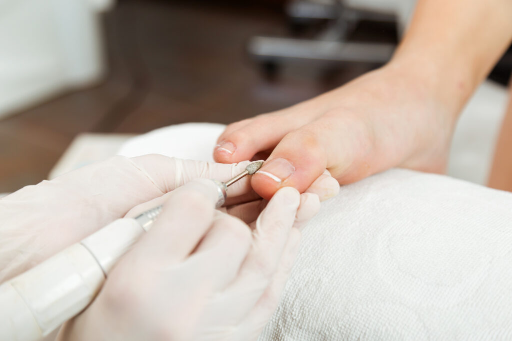Ingrown toenail treatment