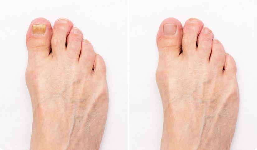 Fungal toenail infection Fungal toenail infection and treatment (ToeFX) Fungal toenail infection